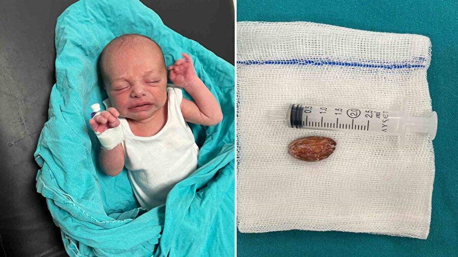 Batman’da 16 günlük bebeğin boğazına badem şekeri kaçtı: Ameliyatla çıkarıldı