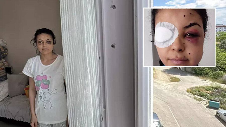 ​Düğünde tüfekle ateş açıldı: Penceredeki Nazar gözlerinden yaralandı