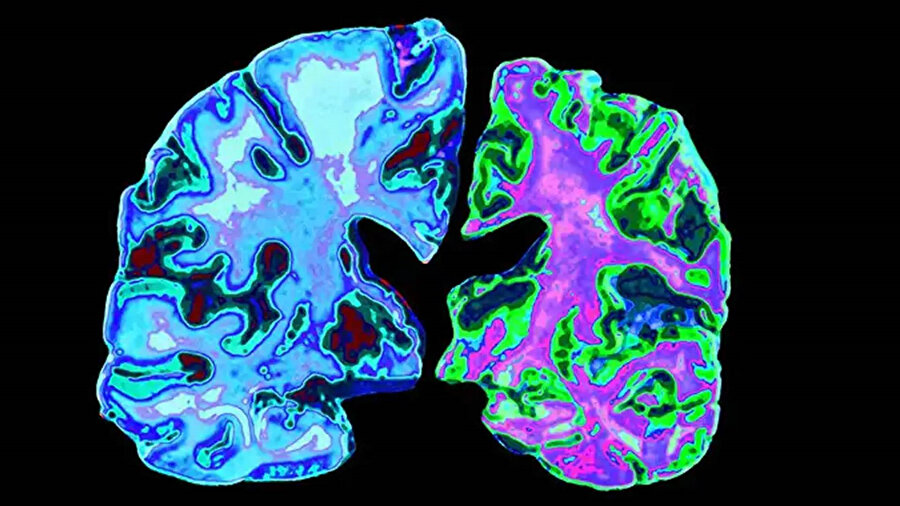 ​​Tıp dünyası şaşkın: En genç Alzheimer hastası olarak kayıtlara geçti