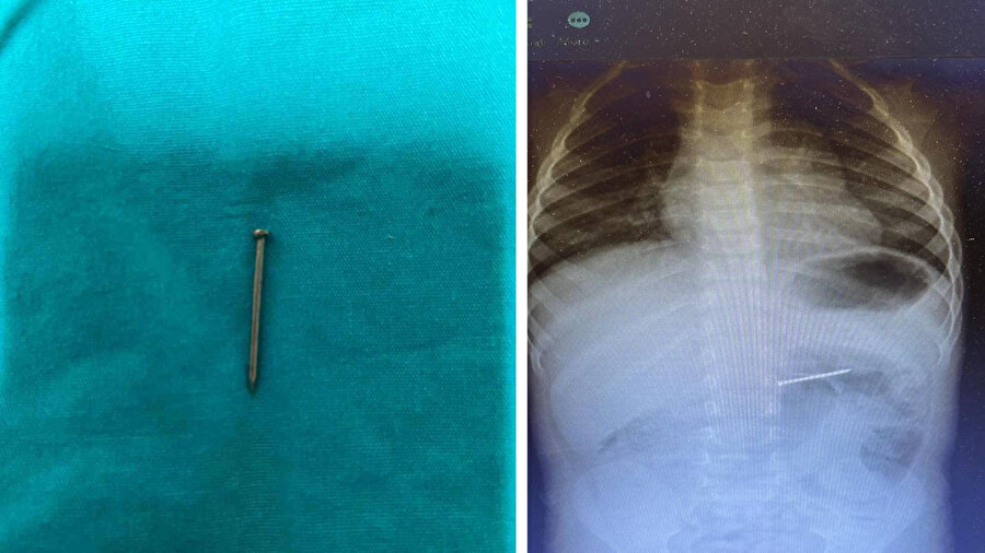 Küçük çocuk 4 santimlik çivi yuttu