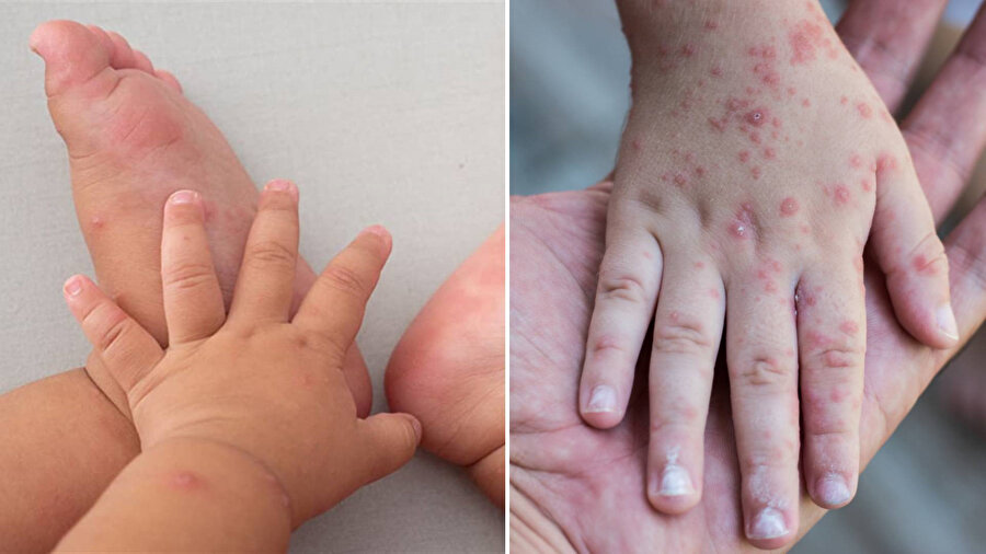 Ebeveynler dikkat: Çocuklar arasında çok hızlı yayılıyor