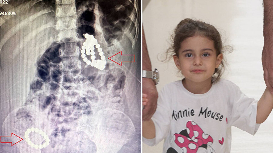 ​Doktorları bile şoke eden vaka: Karnında 66 adet mıknatısla aylarca hayatta kaldı