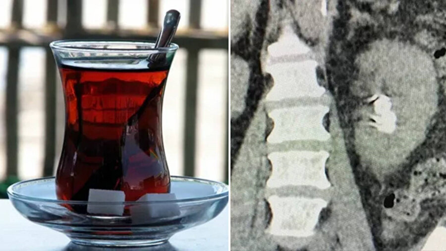 Demli çay tüketiminde 'böbrek taşı' riski