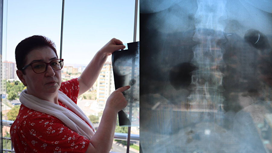 22 yıldır karnında iğneyle yaşıyor: Yaşayan ölü gibiyim