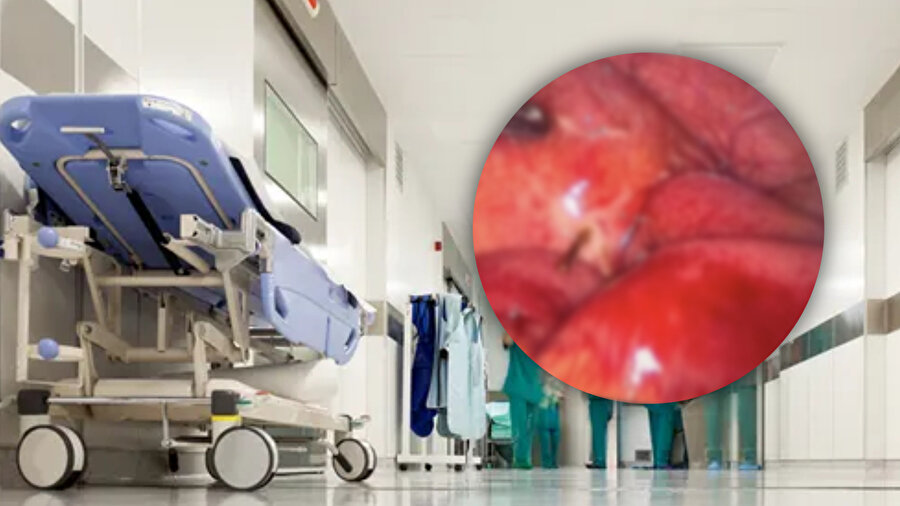 Tavuk yedi, hastanelik oldu: Gerçek ameliyat masasında ortaya çıktı