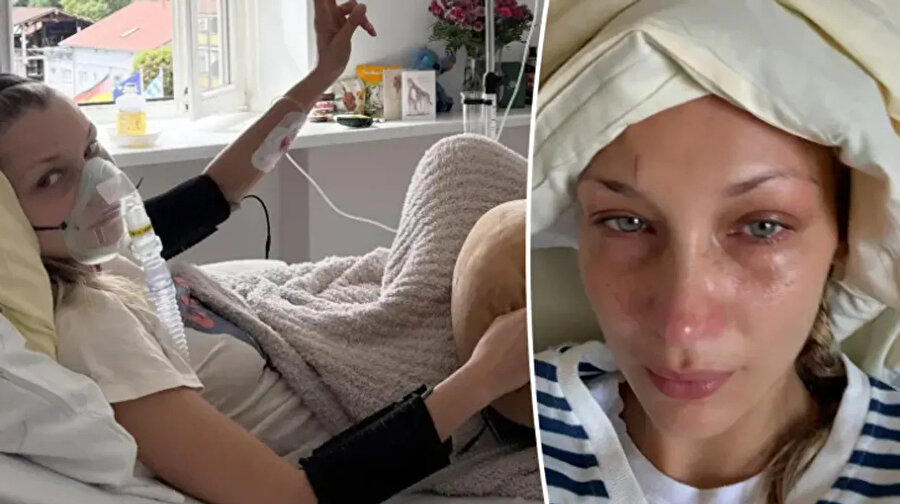 LYME HASTALIĞI NEDİR? Bella Hadid hastalığı ne? Bella Hadid kaç yaşında, nereli?