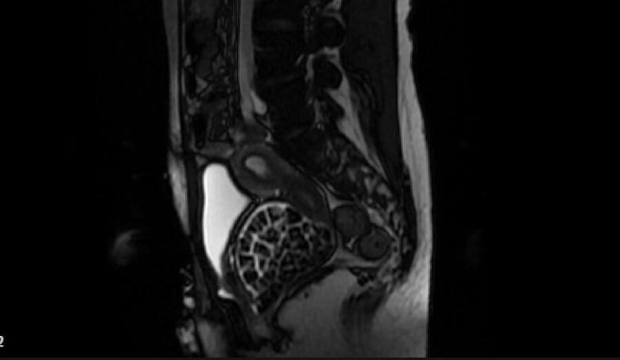 Şok eden ameliyat: 21 yaşındaki genç kızın vücudundan 287 taş çıkarıldı!