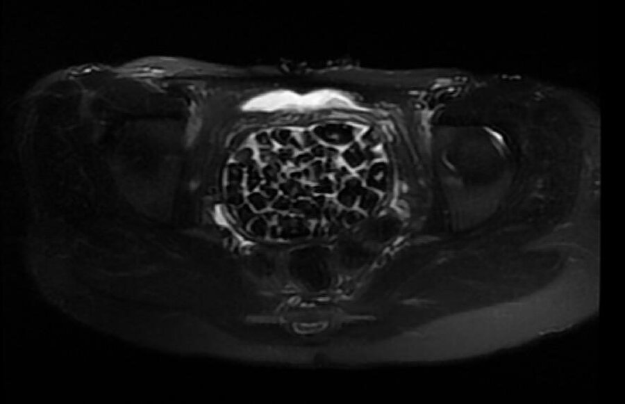 Şok eden ameliyat: 21 yaşındaki genç kızın vücudundan 287 taş çıkarıldı!