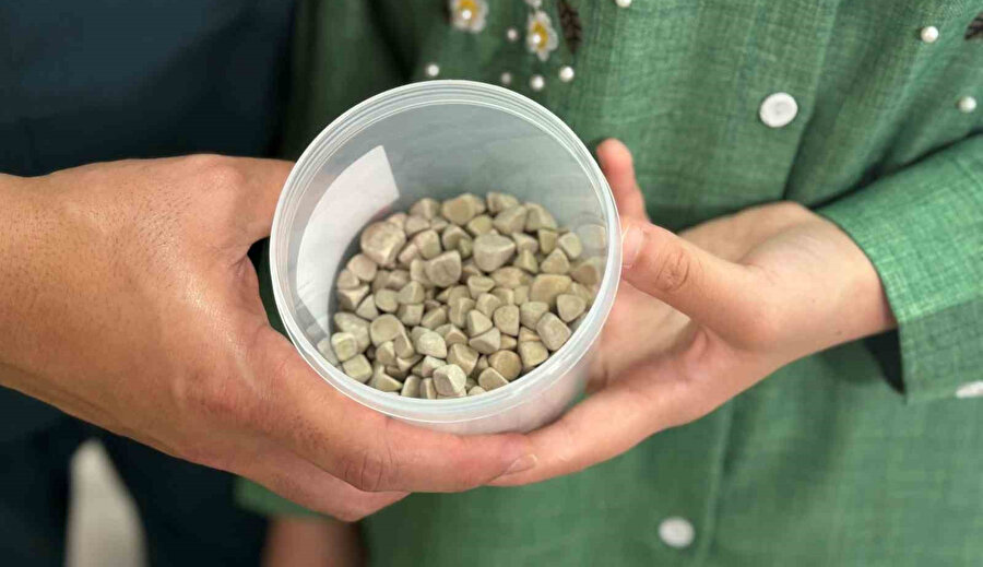 Şok eden ameliyat: 21 yaşındaki genç kızın vücudundan 287 taş çıkarıldı!