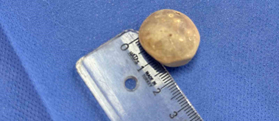 Şok eden ameliyat: 21 yaşındaki genç kızın vücudundan 287 taş çıkarıldı!