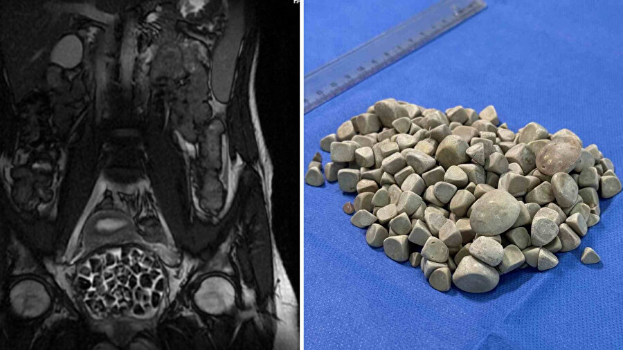 Şok eden ameliyat: 21 yaşındaki genç kızın vücudundan 287 taş çıkarıldı!