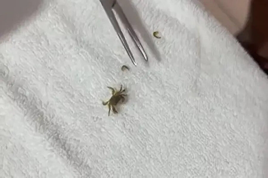 Doktorlar uzun uğraşlar sonucu yengeci çıkardı.