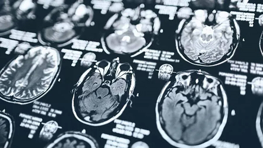 MRI taramaları analiz edildi.