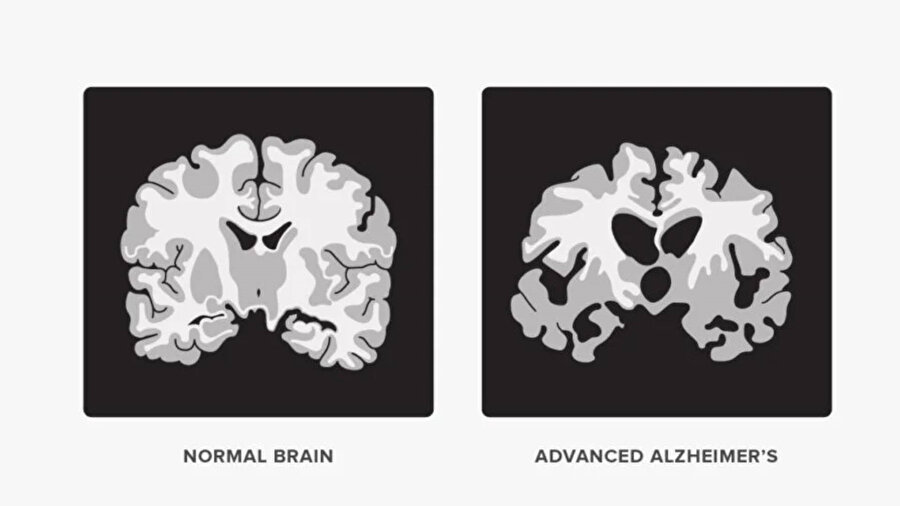 Normal beyin ve Alzheimer'lı birinin beyini