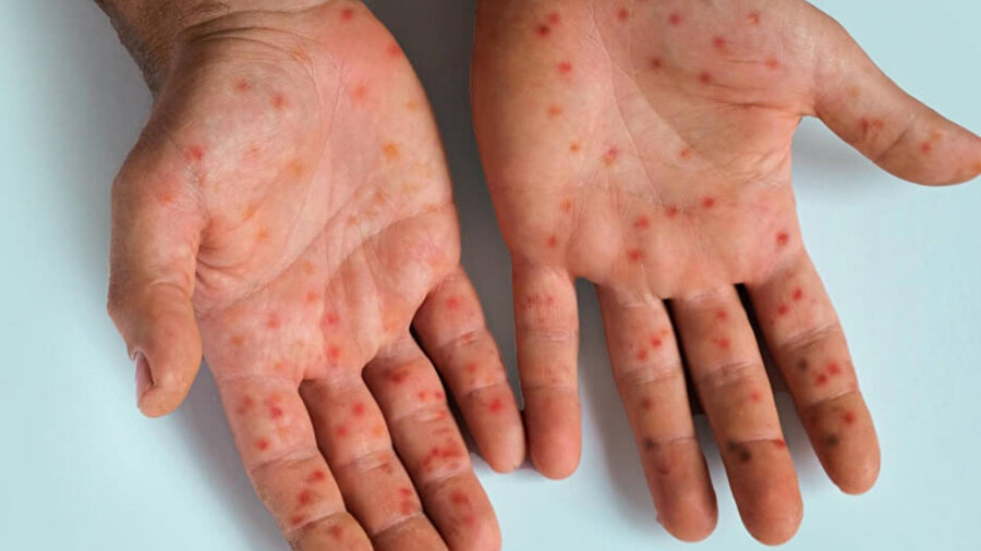 Uzmanlara göre, aşı karşıtı görüşlerin yayılmasıyla birlikte aşılama oranlarının düşmesi salgın riskini artırıyor