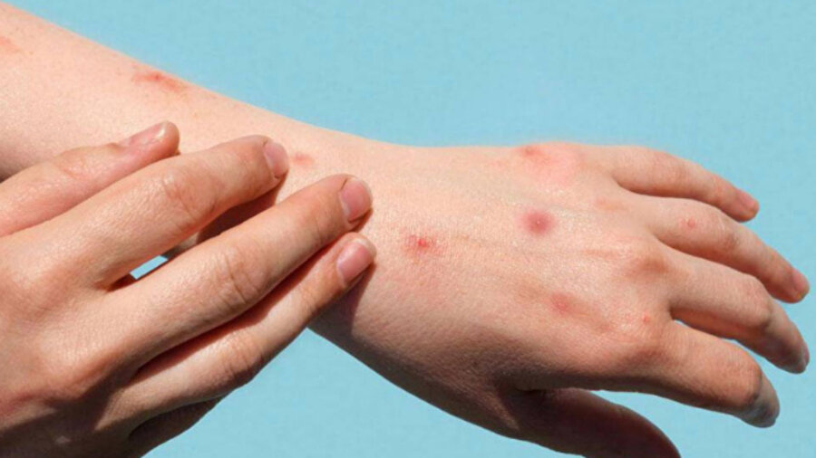 Yeni maymun çiçeği (Mpox) vakalarının tespit edilmesinin ardından acil uyarı yayımladı.