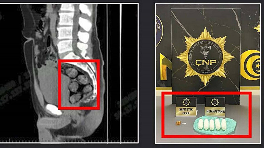 Uyuşturucu midesinden çıkarıldı