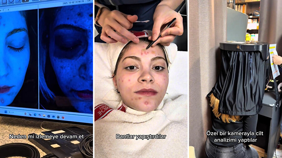 &quot;Kore'de süt içtikten sonra cildim bozuldu.&quot;