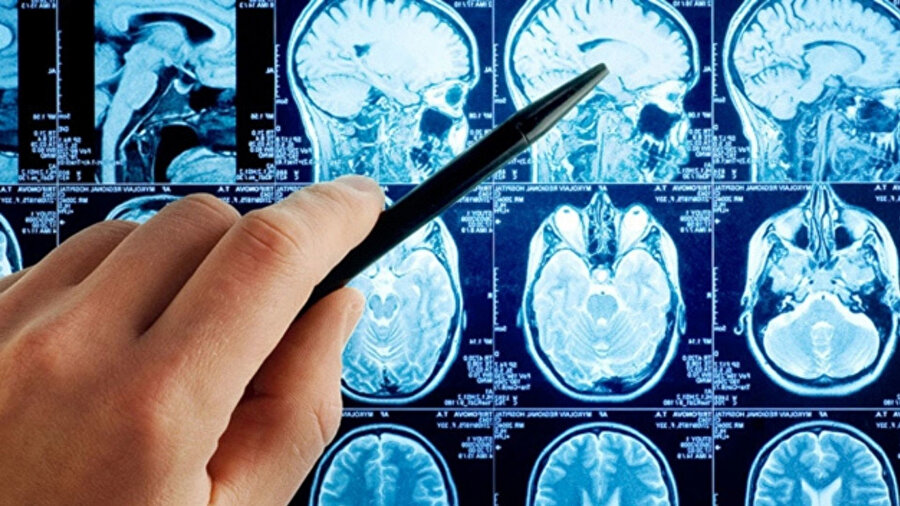 Bilim dünyasında yeni keşif: Sadece 13 kişide rastlandı! Çok nadir görülüyor