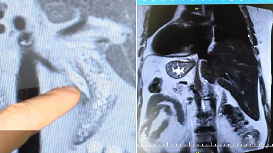 Mide ağrısıyla doktora giden kadın 66 yıl sonra ters tarafta olduğunu öğrendi