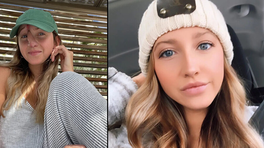 Köpek saldırısı sonrası hayatı kabusa döndü: Üç yılda 16 kez ameliyat oldu!