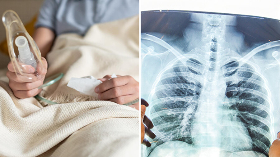 Zatürre tekrar ediyorsa dikkat: Uzmanlar sinsi tehlikeye dikkat çekti