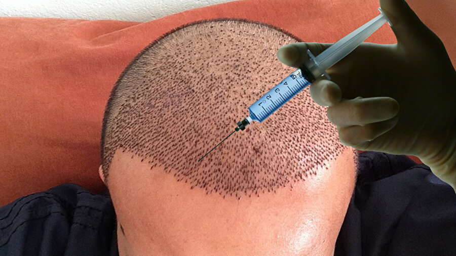 ​Sahte saç ekim uzmanı ortaya çıktı