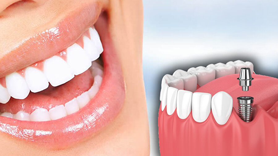 Diş tedavisinde yeni dönem: İmplant SSK kapsamına giriyor