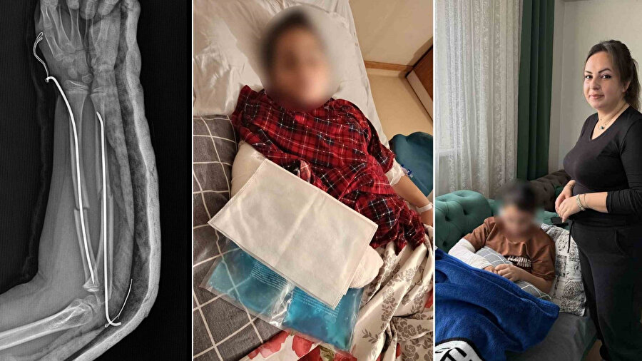 9 yaşındaki çocuk arkadaşının kolunu iki yerinden kırdı