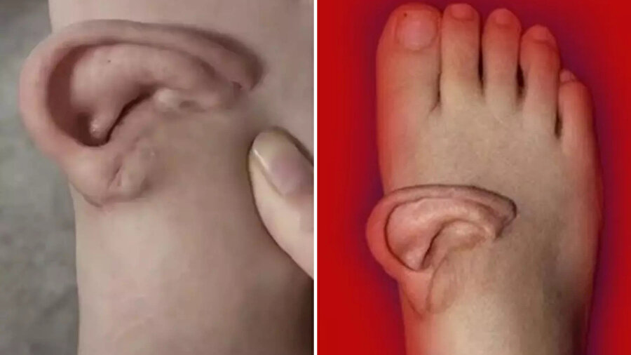 Tıp dünyasını şaşkına çevirdi: Kopan kulağını 5 ay ayağında taşıdı