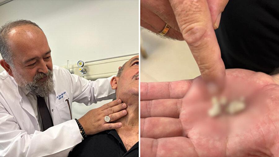 Ağzından taş geliyordu: Tükürük bezinden çıkanlar şoke etti