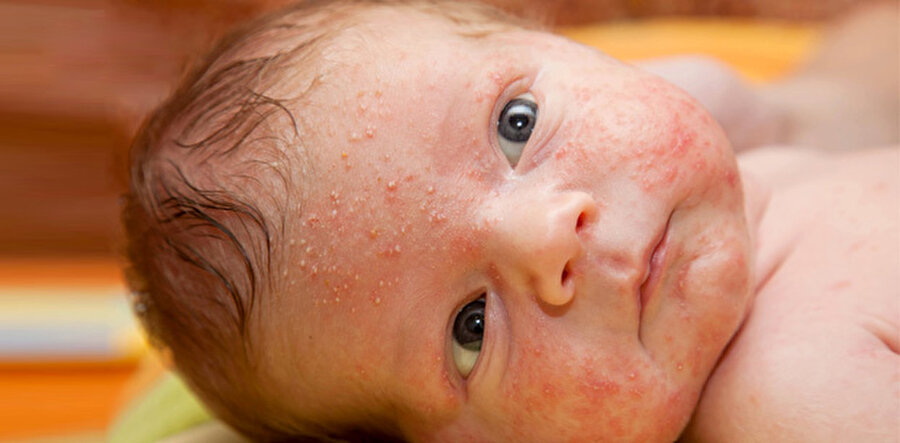 Daha az alerji riski...

                                    
                                    
                                    
                                    
                                    Anne sütü alan bebeklerde ilk 6 aylık dönemde de, sonraki ek besin döneminde de gıda alerjilerine mama ile beslenen bebeklere oranla daha az rastlanıyor.
                                
                                
                                
                                
                                