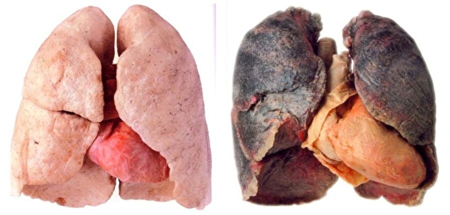 Akciğer kanseri öldürüyor!

                                    
	Uzmanlar, akciğer kanserinin en çok ölüm nedeni olan kanser türü olduğunu söylüyor. 

                                