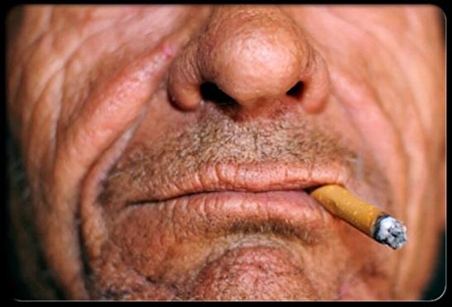 Sigara akciğer kanserine neden olur

                                    
	Özellikle aşırı sigara tüketimi nedeniyle yaygınlaşan akciğer kanserinin tek tedavi yöntemi ameliyat. 

                                