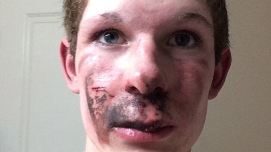 
                                    
                                    
                                    Almanya'da gerçekleşen olayda 16 yaşındaki Ty Greer, elektronik sigaranın düğmesine bastıktan birkaç saniye sonra patlama şoku yaşamış dişleri parçalanmış, dili ve boğazının arkası yanmıştı.
                                
                                
                                