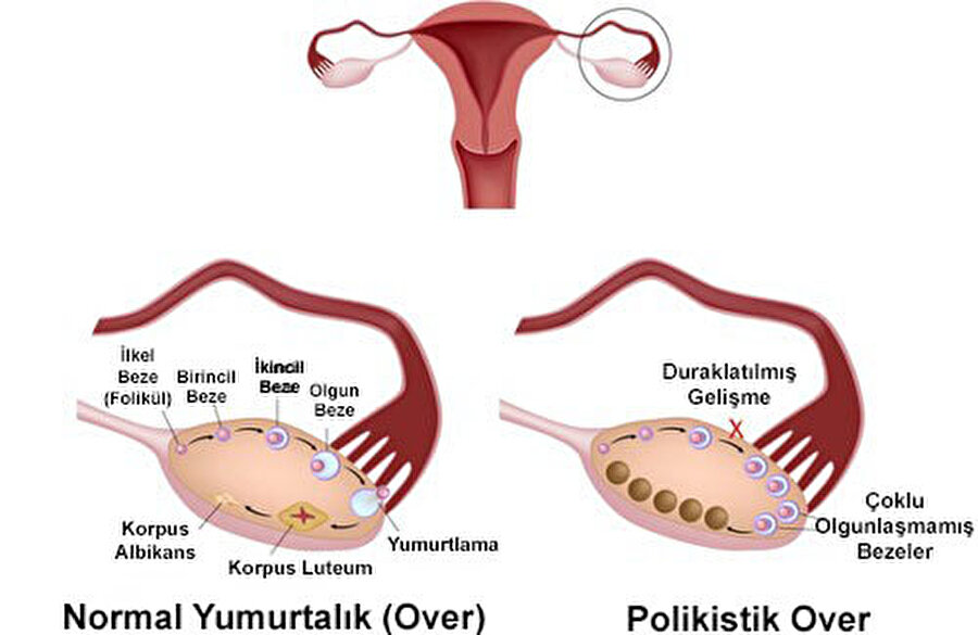 Polikistik Over Sendromu nedir?

	
		 Kadınların yumurtlama probleminin önde gelen sebeplerinden olan “Polikistik Over Sendromu”, yumurtalıklarda çok sayıda kist görünümüyle ilgilidir. Genellikle 30 yaş altı kadınlarda bir takım hormonal düzensizliklerle beraber görülen ve nedeni tam olarak bilinmeyen bir durum, genetik ve çevresel faktörlerden de kaynaklanabiliyor.
	
