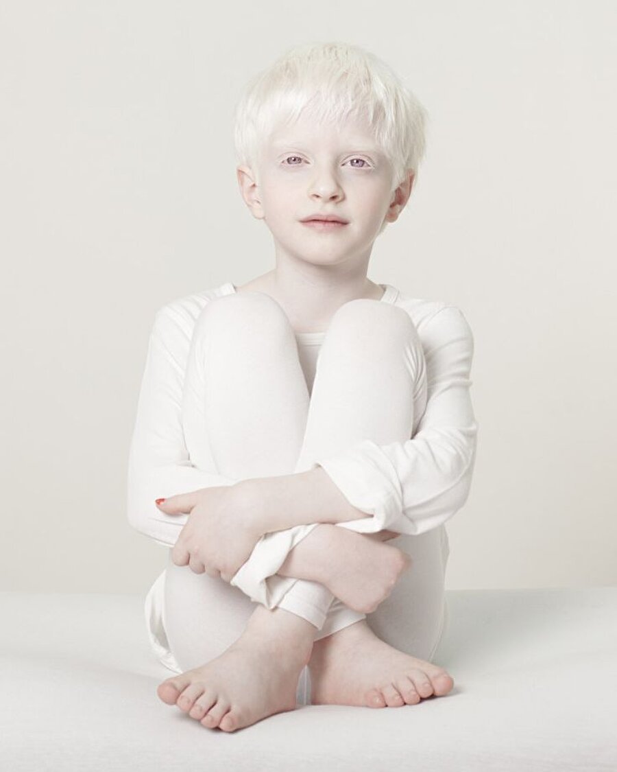 Yulia Taits yorumu
Fotoğraf sanatçısı Yulia Taits, albino hastalarını birer masal kahramanı olarak betimliyor.