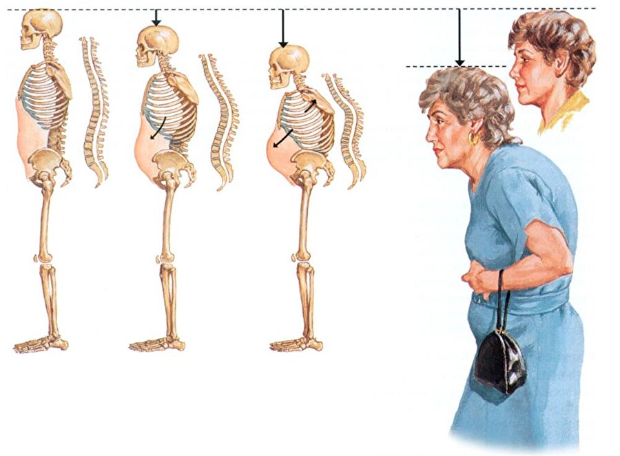 Osteoporoz
Kemik dokusunun içinde anormal derecede boşluklara neden olan osteoporozun önlenmesi ve tedavisi sürecinde beslenme önemli bir rol oynamaktadır.

Kalsiyum bakımından zengin yoğurt, kemik yoğunluğunun korunmasında ve hastalığın gelişiminin yavaşlatılmasında tüketilmesi önerilen gıdalar arasında ilk sıralarda gelmektedir.

Kemik sağlığını korumak ve kemikle ilgili hastalıklara önlem almak için önerilen günlük kalsiyum miktarı 1000-1300 mg arasındadır. Bu miktarı yağsız organik yoğurt, yağsız peynir çeşitleri, beyaz fasulye, kale, brokoli ve yağsız süt gibi gıdalardan alabilirsiniz.


