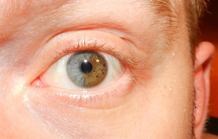 Göz rengini değişebilir mi?

                                    
                                    
                                    Yapılan bazı lazer operasyonları göz rengini değiştiriyor. Operasyonun ardından göz rengi birkaç hafta içinde maviye dönüyor. 
                                
                                
                                