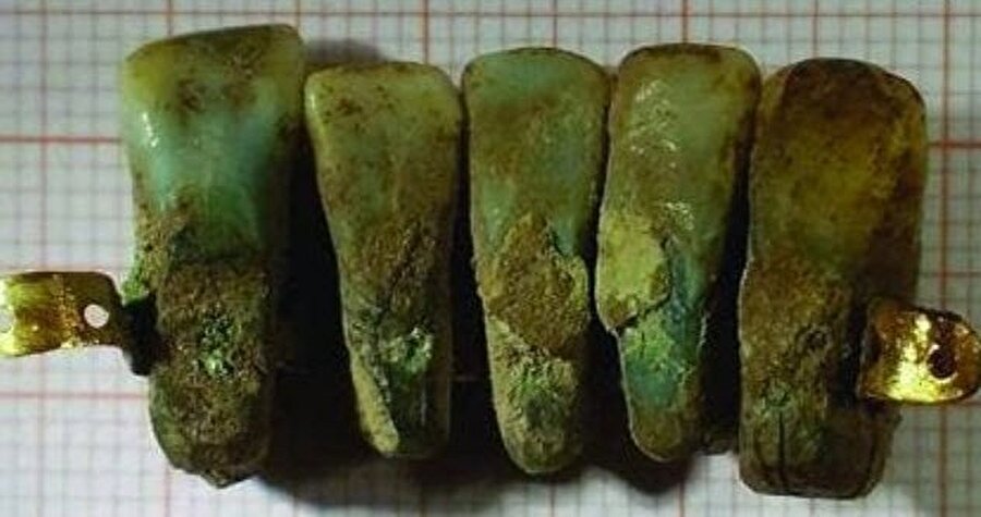 Takma diş
Dünyanın en eski takma dişinin, gerçek insan dişlerinden tasarlandığı yapılan çalışmalarla kanıtlanmıştır.