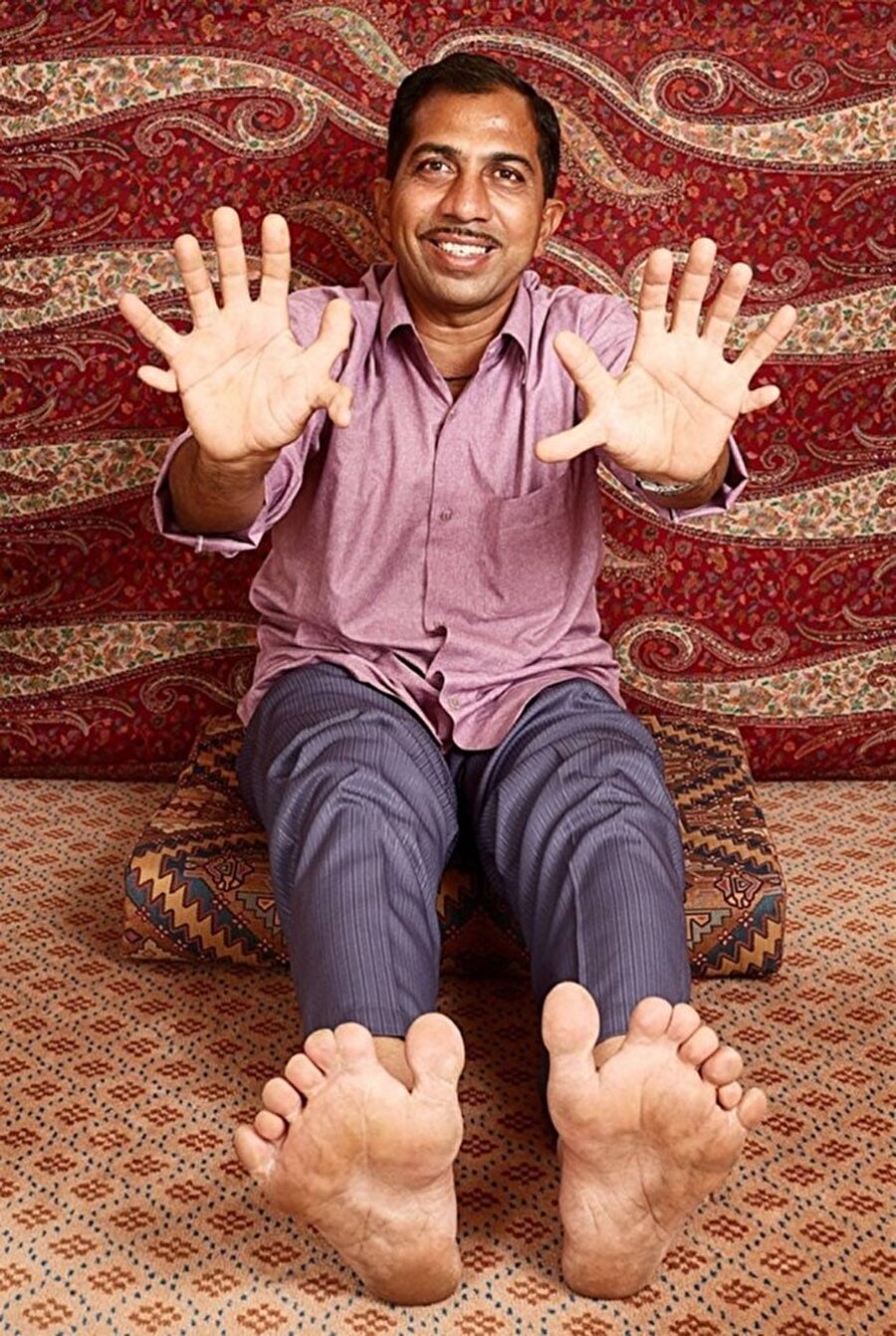 Devendra Suthar
Suthar en çok parmak sahibi insan şu an. Tam tamına 28 parmağı var.