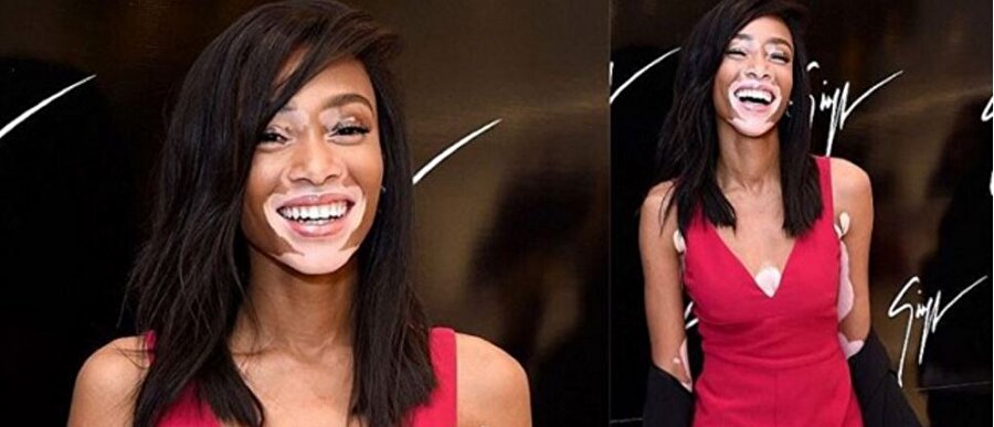 Winnie Harlow
Jamaika asıllı Amerikalı manken 4 yaşından bu yana vitiligo hastası. Çocukluk döneminde arkadaşlarının "inek ve zebra" olarak lakap taktığı Winnie bu nedenle eğitim hayatına devam etmedi. Ancak hiçbir zaman hayallerinden vazgeçmeyen Winnie, dünyanın en tanınan mankenlerinden biri oldu.