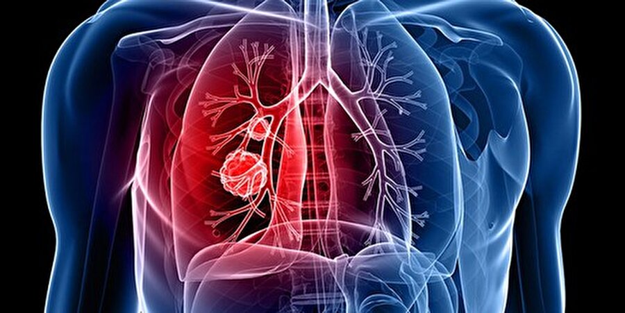 Kokudan akciğer kanseri teşhisi 

                                    Şimdilerde bilim insanları, soluk verirken çıkan molekülleri inceleyerek akciğer kanserini teşhis etmenin ne kadar mümkün olduğunu anlamaya çalışıyor.
                                