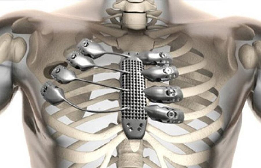 
                                    
                                    
                                    Günümüzde 3D yazıcılarda çoğunlukla seramik, polimer ve metal maddeleri kullanılmaktadır. Fakat gün geçtikçe ve teknoloji geliştikçe bu yazıcılarda kullanacağımız ham maddelerde de değişiklik olabilir. 

 Bizim konumuz ise 3D yazıcılar ile sağlık alanında kullanımlarıdır. Genel anlamda, yapay organ yapımı, eksik kemik parçalarını tamamlama, bireye özel implant tasarlama ve ameliyat öncesi gerekli modeli oluşturmak için kullanılmaktadır. 
                                
                                
                                