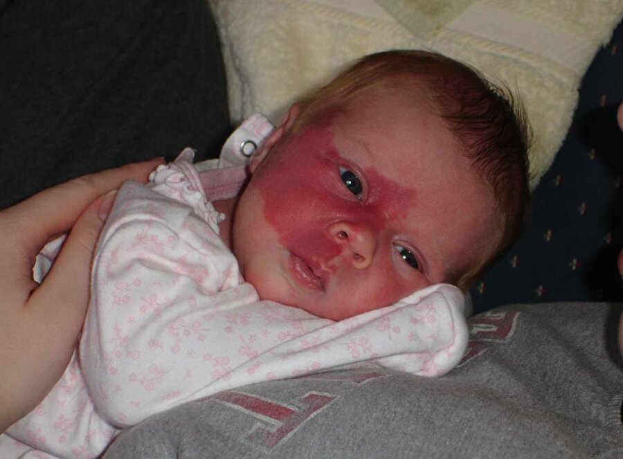 
                                    
                                    Doğum lekesi genellikle yüz ve boyunda görülür.
                                
                                