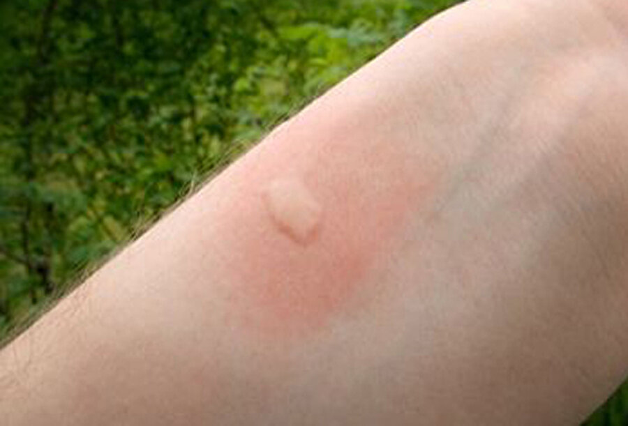 Acıyı azaltır
Böcek ve sinek ısırıklarının olduğu bölgeye karbonat sürerseniz, acınız hafifler. 