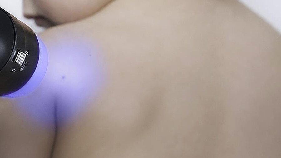 21 onkoloji uzmanının bulguları karşılaştırıldı
Daha sonra yapay zekaya, en yaygın cilt kanseri türüne "karsinom", en ölümcül olana ise "melanom" işareti koyması öğretilerek, elde edilen sonuçlarla 21 onkoloji uzmanının bulguları karşılaştırıldı.

Karşılaştırma sonucunda, yapay zekanın da neredeyse onkoloji uzmanlarıyla eşit düzeyde ''doğru teşhis'' yapabildiği görüldü.

Çalışmanın sonuçlarının oldukça "heyecan verici" olduğunu dile getiren Stanford Üniversitesi araştırmacıları, geliştirilen yapay zekanın kliniklerde de test edileceğini ifade etti.

Cancer Research UK araştırmacıları da söz konusu teknolojinin doktorlar için çok faydalı bir araç olabileceğini kaydetti.