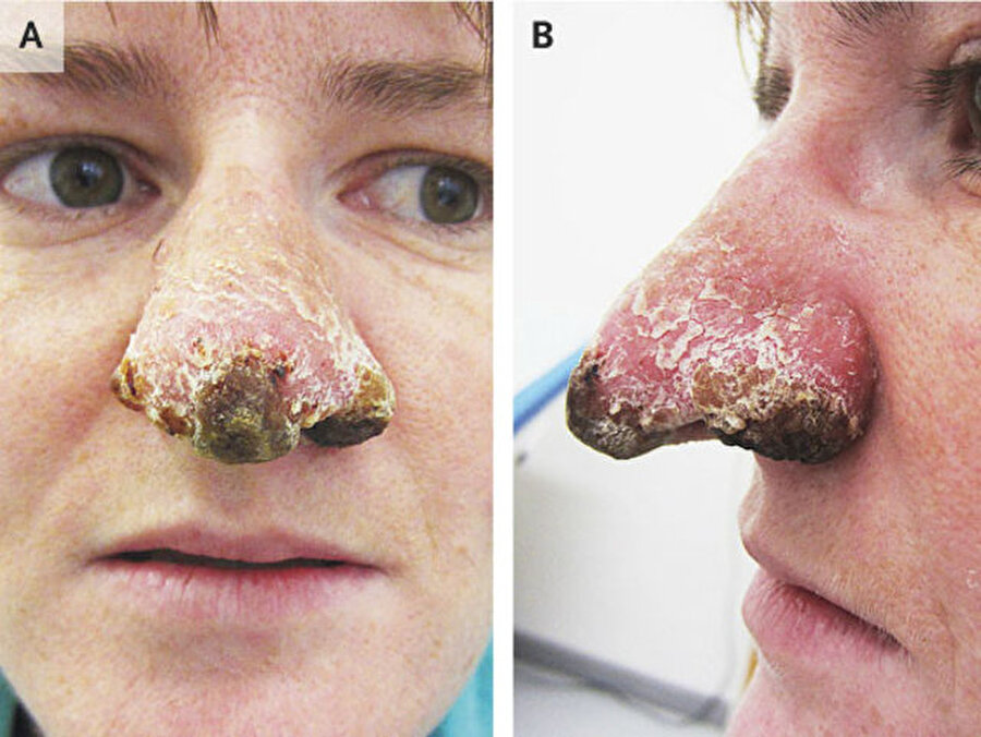 
                                    
                                    
                                    
                                    
                                    Genç kadının burnundaki ülserden alınan parça biyopsiye gönderildi.
                                
                                
                                
                                
                                