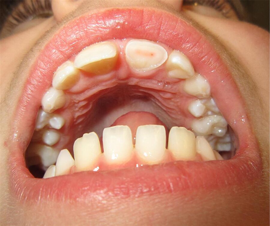 Bağ dokuları mutlaka alınmalı

                                    
                                    Uzmanlara göre; özellikle üst ve alt dişlerin arasında konumlanan dudak bağları, bulundukları bölgeden uzaklaştırılmalı, ardından ise ortodontik diş teli tedavisi uygulanmalı. Dudak bağları alınmayan kişilerde diş teli uygulamaları yapılsa dahi, istenilen sonucun elde edilemeyeceğini belirten uzmanlar, dişler arasında birleşme sağlanamayacağını da söylüyor.
                                
                                