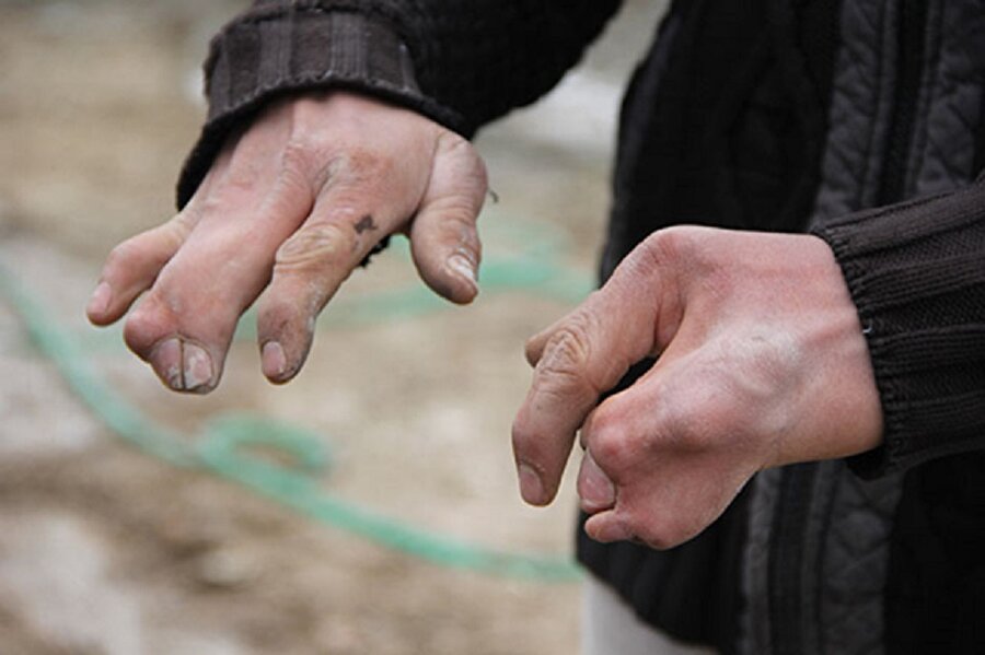 Altı parmak hastalığı